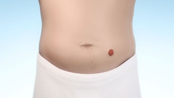 Animated front profile of an abdomen with a stoma