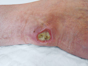 MRSA Pictures: MRSA Skin Infection Symptoms - WebMD