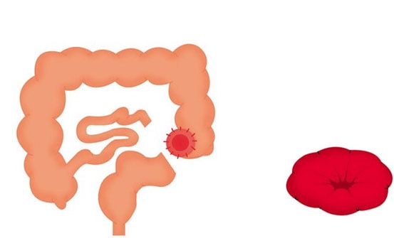 Formation of a stoma