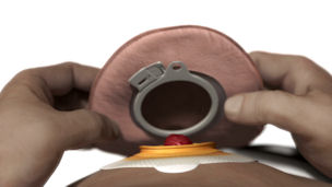 Person applying a 2 piece ostomy click system
