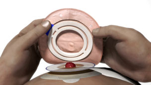 person applying a 2 piece ostomy flex system