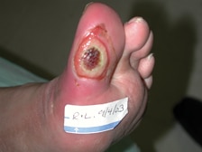 Ulcère du pied infecté