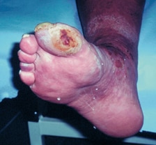 Ischemic foot ulcer