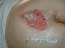 The ulcer after one week of treatment.