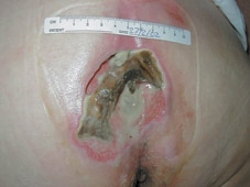 The ulcer at the start of treatment.
