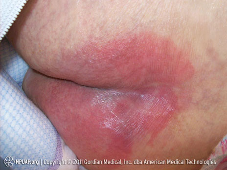 Catégorie d'ulcère de pression/stade I : Rougeur non blanchissable sur une peau intacte.