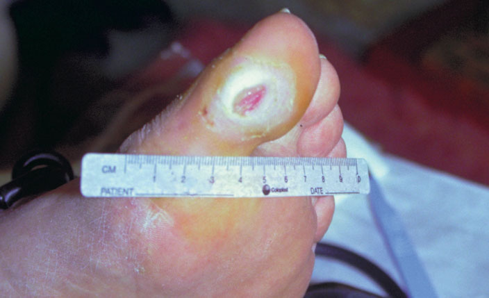 ulcère du pied neuropathique