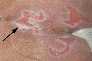 Dermatite associée à l’humidité périlésionnelle
