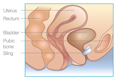 sling system