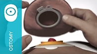 Step 2: Applying a 2-piece SenSura Click urostomy pouch