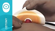 Step 5: Removing a 2-piece SenSura Click urostomy pouch