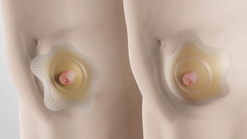 Le SenSura Mio Concave pour les personnes ayant une zone bombée, une hernie ou une stomie sur l’abdomen.