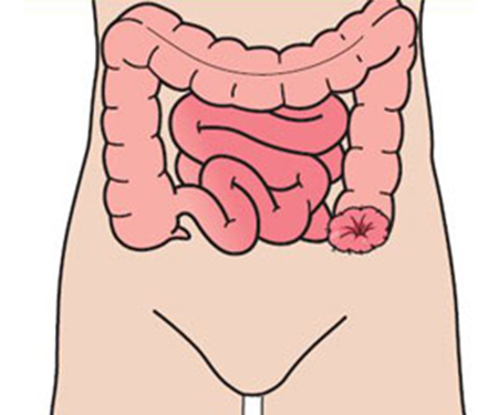image of colostomy