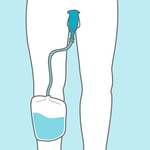 Removing the male external catheter