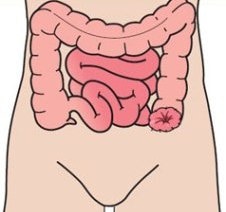 Location of a colostomy